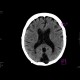 Cisterna cerebellomedullaris permagna: CT - Computed tomography